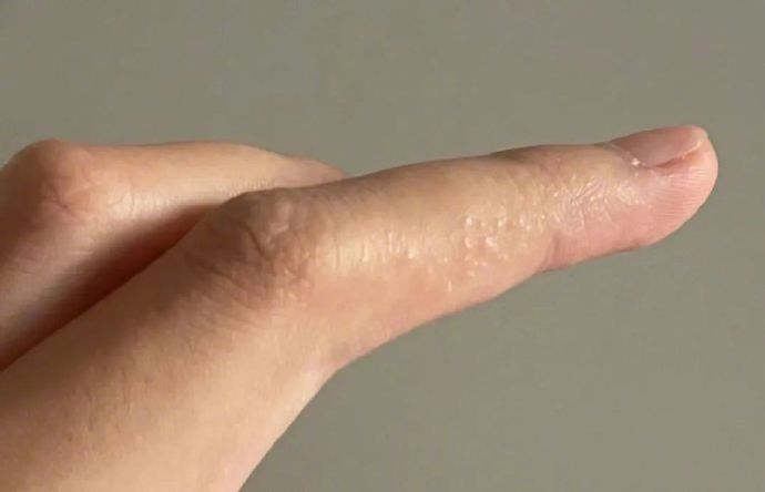 为什么一到夏天,手上就长汗疱疹?