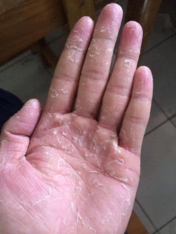 老中医的一草二皮汤治疗手足癣,灰指甲效果好