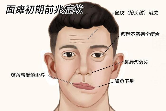 脑梗塞部位及症状图片图片