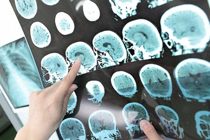 超94万人数据,每多做一次ct,患这种癌风险高43%