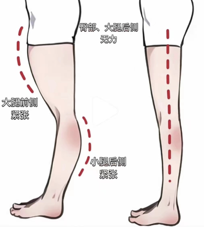 左边为膝超伸体态,右边为正常体态.