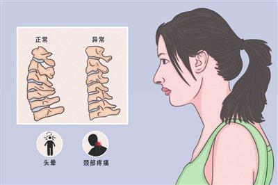 颈椎压迫脊髓早期症状图片