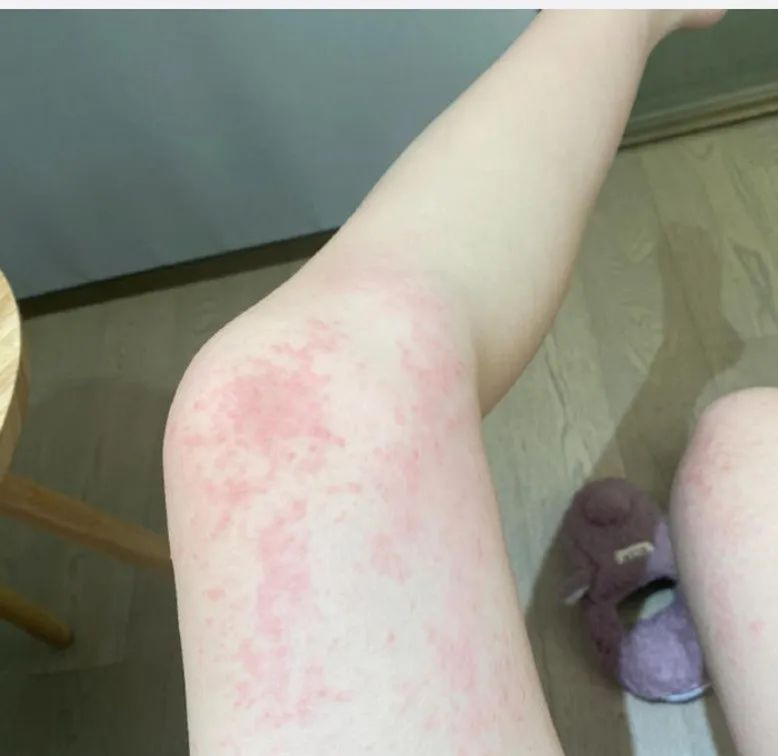 赵露思现身上海就医!皮肤状态发红起疹,怕风怕花粉怕刺激引热议