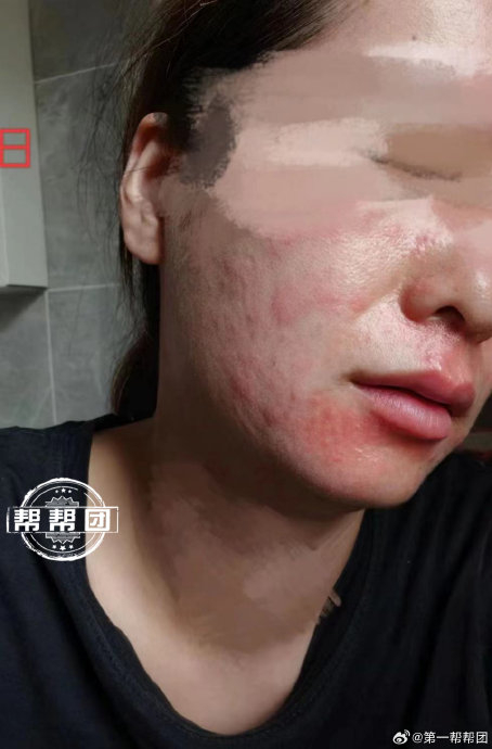 美容成"烂脸" :美容院"针清"敷面膜,女子脸部大范围红肿过敏