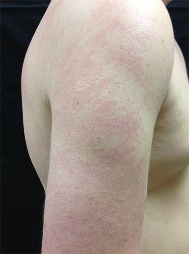 毛周角化症（来自参考资料）