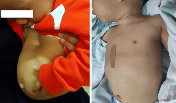 Wang手术前后对比，图/受访者