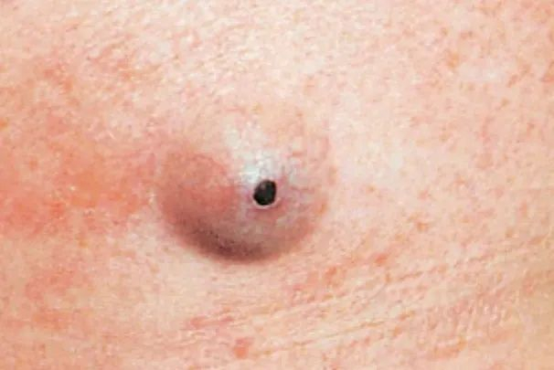 图片来源：《麦基皮肤病理学 第4版》