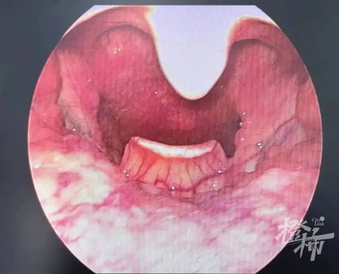 喉咙难受时喝点啤酒很爽口?00后小伙这个举动差点要了命