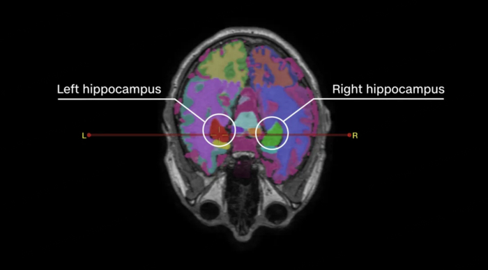 脑成像显示Nicholls海马体体积的增大