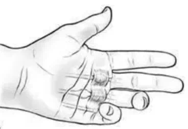 手指屈肌腱腱鞘炎。 图/北京协和医院公众号