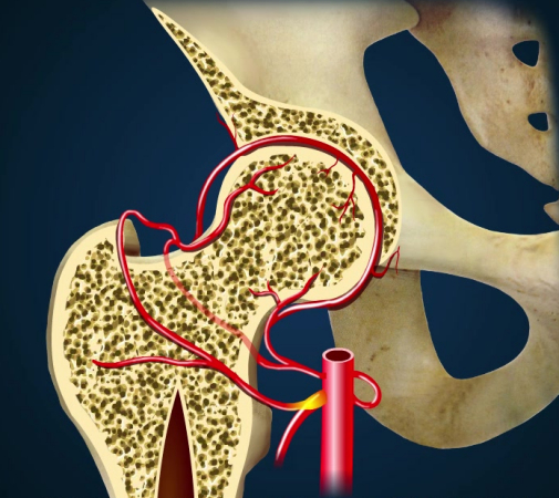 股骨头坏死是因根源供血障碍导致股骨头内组织细胞坏死,引发的一系列