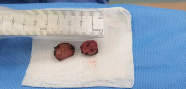 丁丁里植入三颗珠子?玩大了,又痛又肿