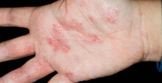 图2. 汗疱疹（来源：https://www.nhs.uk/conditions/pompholyx/）