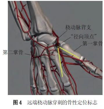 桡动脉穿刺适应证及禁忌证