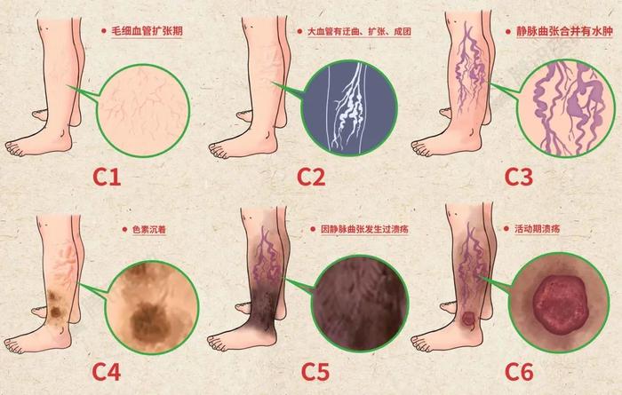 静脉曲张六个阶段图片