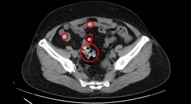 △CT影像显示，患者肠道内有不少杨梅核滞留
