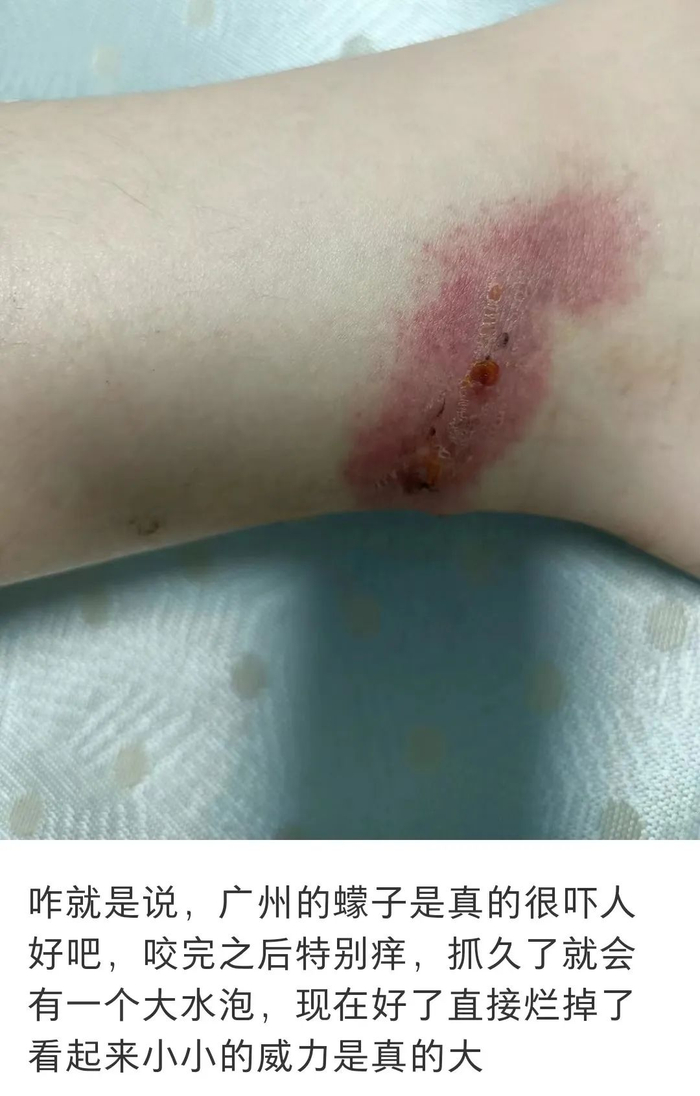 "凶残程度让人不得不怀疑有人说,这蠓比蚊子毒多了,关键是它咬人没