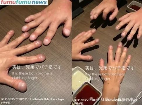 哥哥在读初中的时候,发现自己的手指不