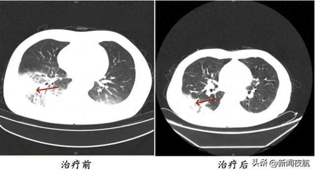 接连两人确诊，严重者可致死！几乎家家在用，紧急提醒→-确诊死亡病例