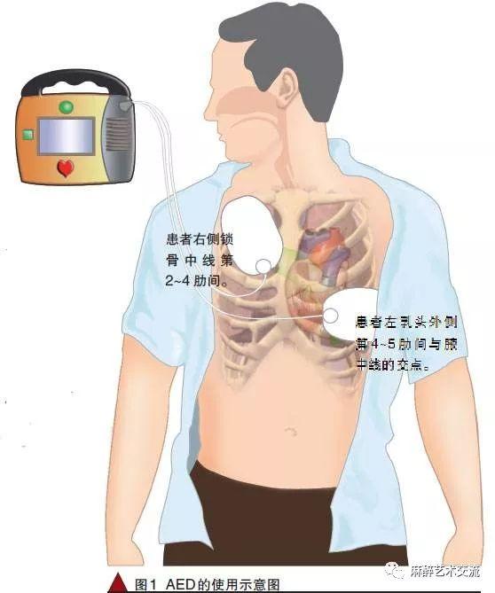 飞利浦除颤仪使用图解图片