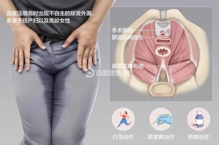 这些都是盆底受损后盆底功能障碍性疾病的表现,不仅严重影响女性生活