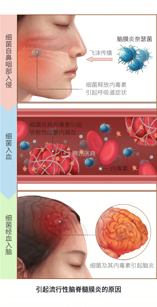 脑膜炎_新浪新闻