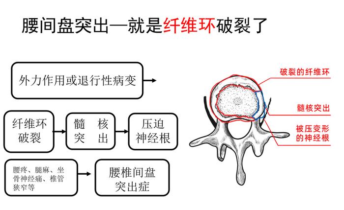 腰椎间盘突出