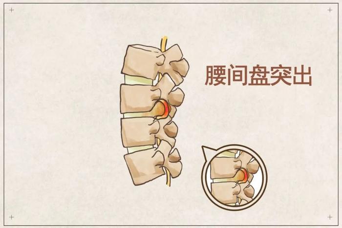 腰椎间盘突出