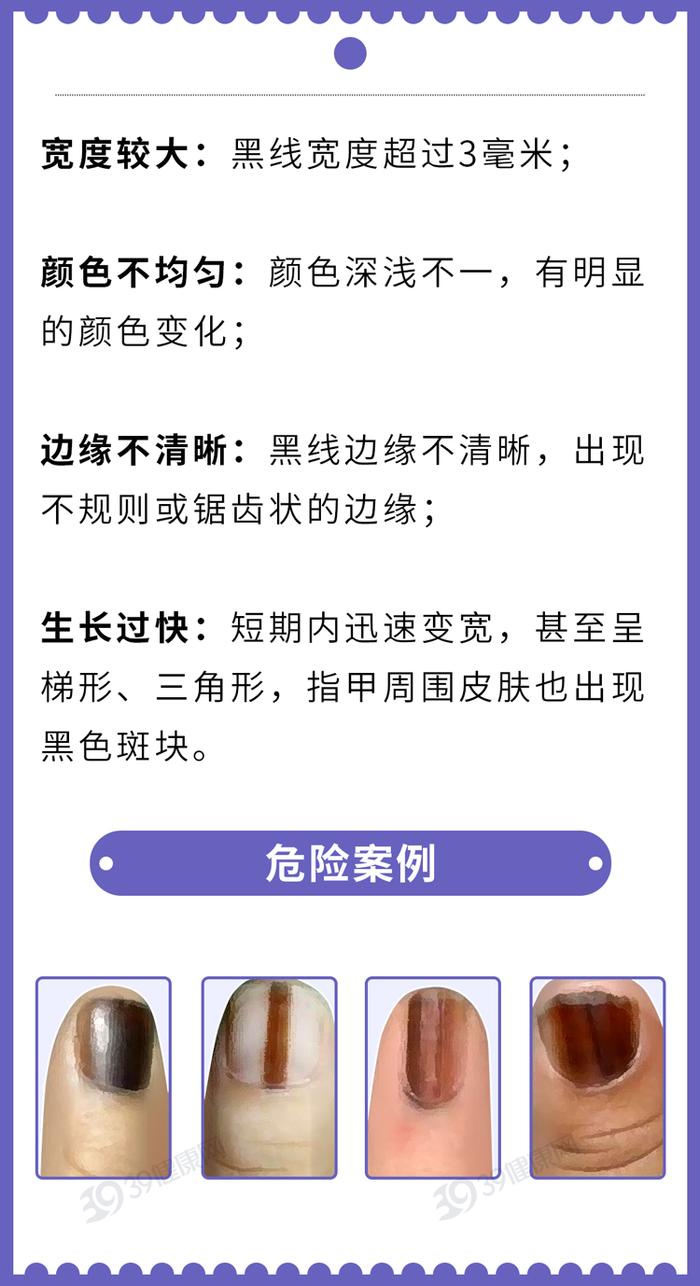 一般来说,甲母痣大多是良性的,癌变的概率不大,除非出现这4种情况,就