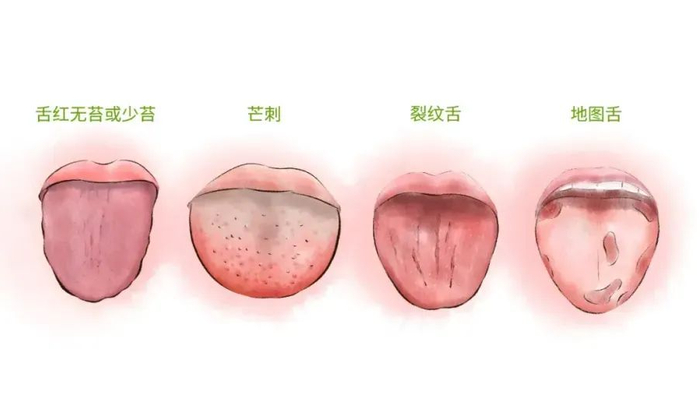 阴虚体质的孩子舌头非常红,舌苔很薄,甚至没有舌苔.1.