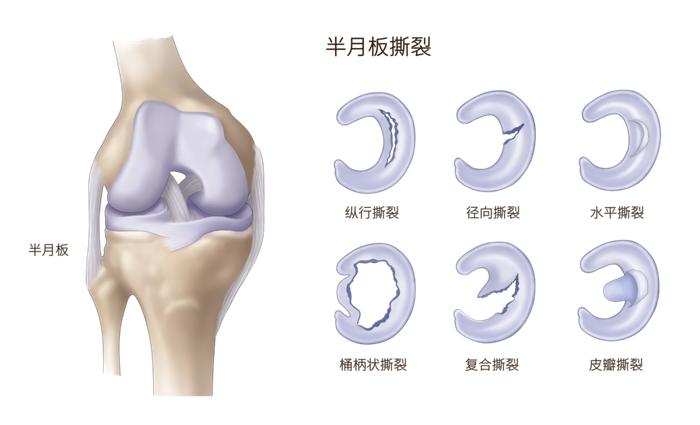 膝关节半月板图解图片