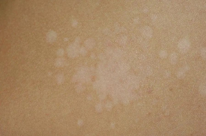 一到夏天很多人身上长这种白斑,其实是真菌感染!