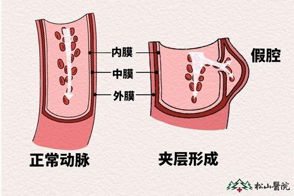 半月瓣是主动脉瓣吗图片