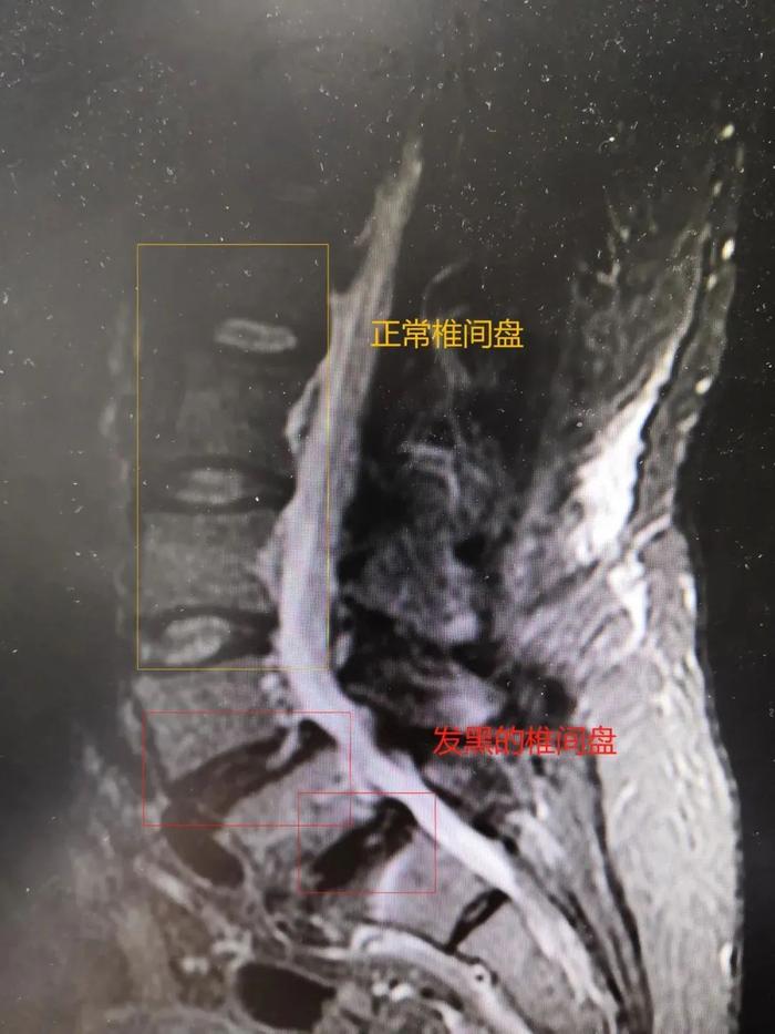 x片,ct,磁共振,三连拍检查下来,医生发现,小赵腰椎间盘变性,突出,腰椎