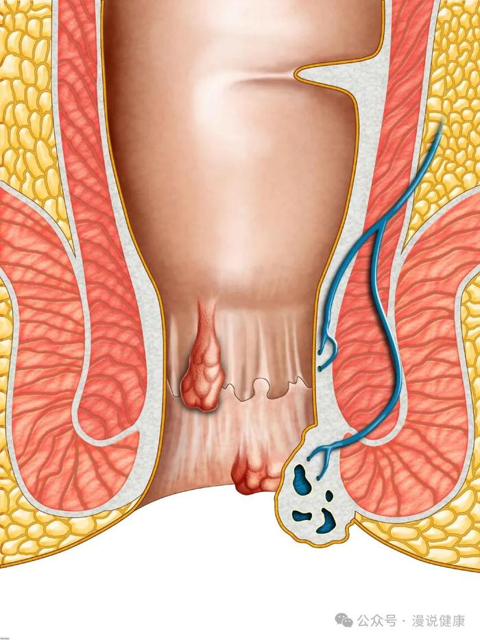 为何痔疮发病率这么高?这多半与4个因素有关,需警惕