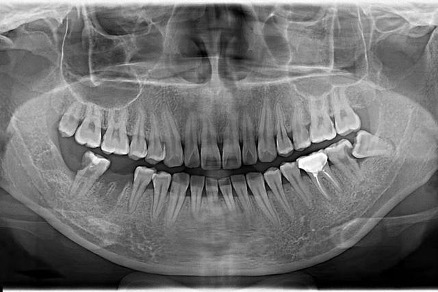 什么是口腔全景片