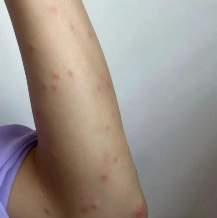 先从家里检查↗|荨麻疹|丘疹性|蚊虫_新浪新闻