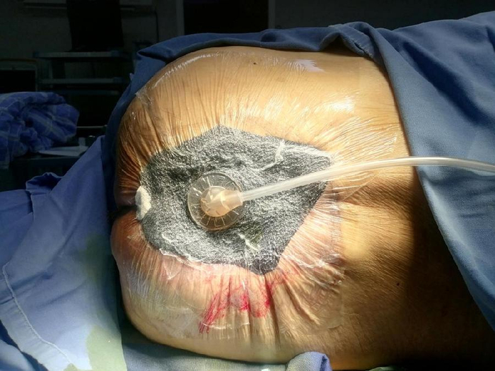 鉴于外院治疗不佳,为加速康复并提升皮瓣移植成功率,医疗团队实施多次