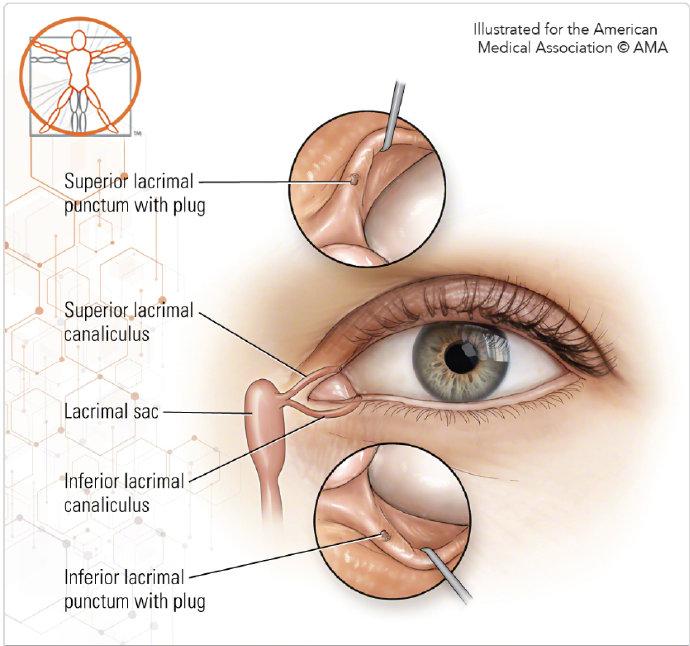 泪小管瘘图片