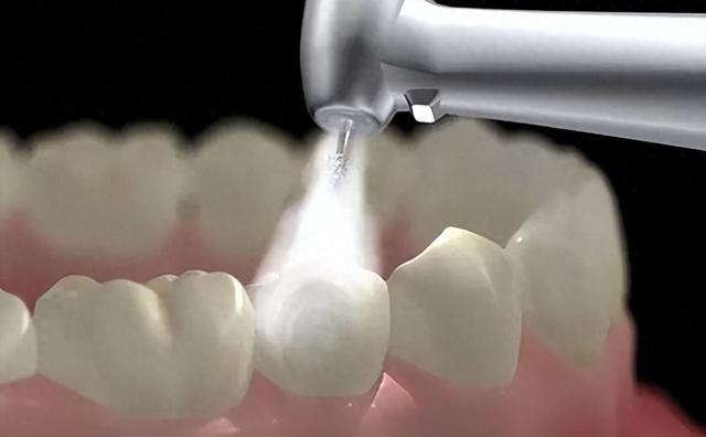 牙齿喷砂是牙齿美白洁牙的一种方法,它通过使用高压气流将特制的喷砂