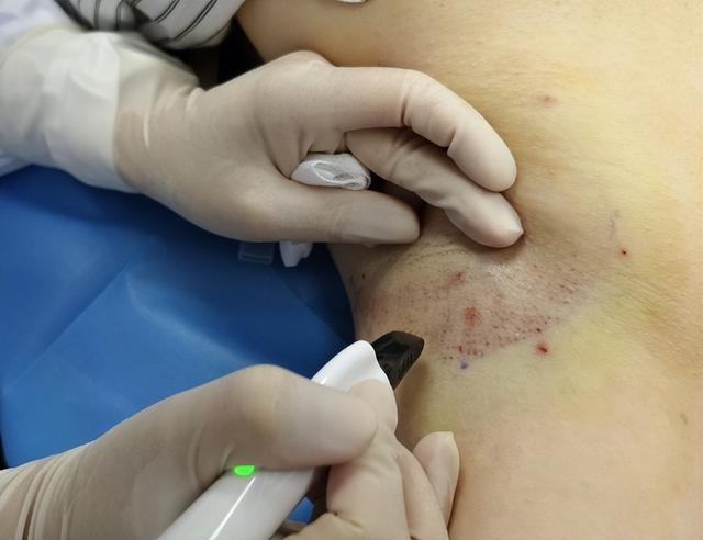 黄金微针射频黄金微针射频术,适用于12岁以上,腋下的臭味严重影响了