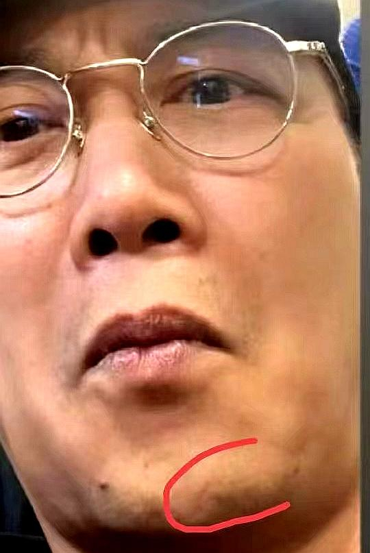 陈奕迅受伤一个月首露面,下巴缝了30针的疤痕好长,恢复情况曝光