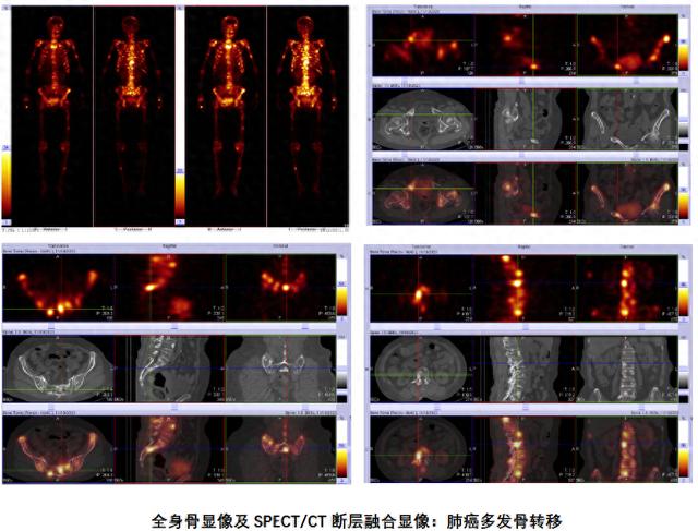 全身骨显像报告解读图片