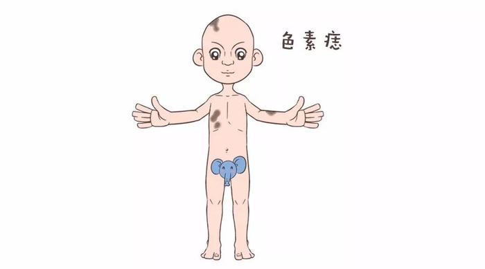 这种胎记竟然会癌变?这几种居然不会消退?