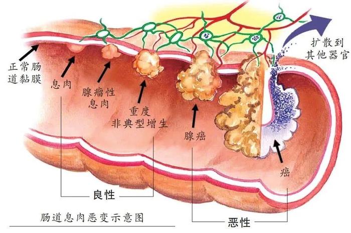 息肉图片