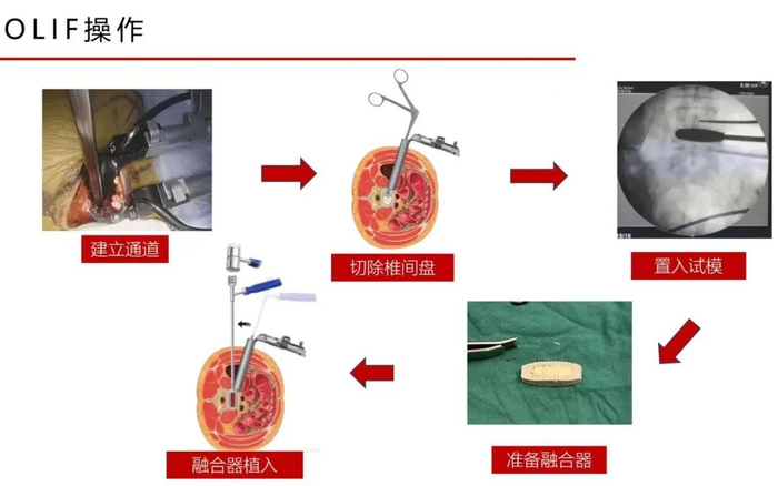 七旬老人腰痛折磨5年,术后一天下床走路!是什么手术消除"脊苦"?