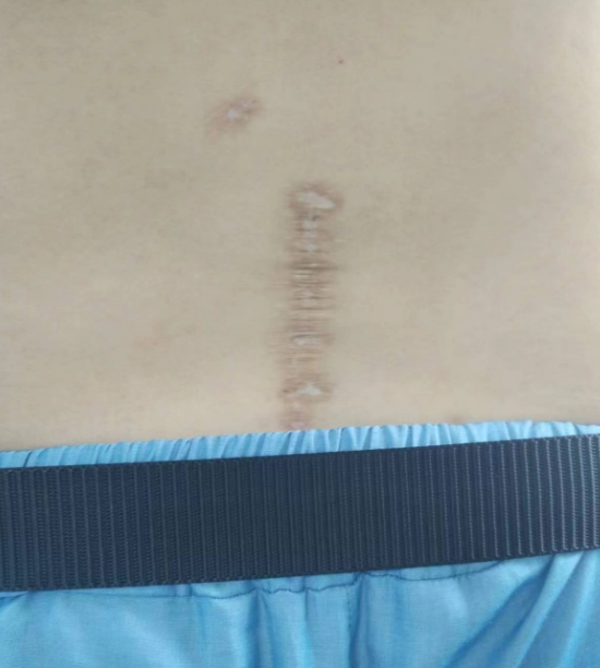 术后图片。作者提供