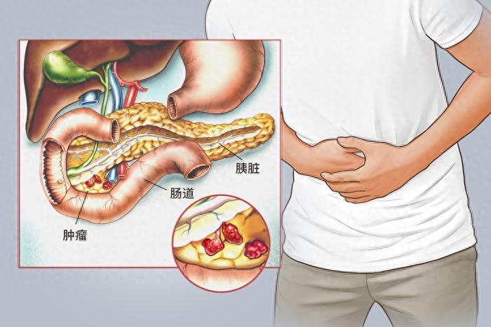 癌王胰腺癌很会伪装 提醒 身体出现4个异样