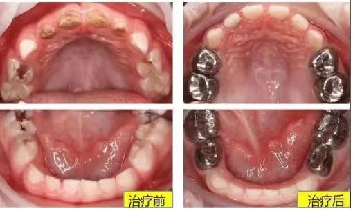 遗传性牙本质发育不全图片