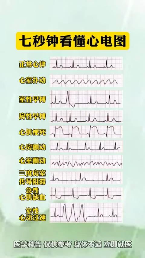 七秒钟学会看懂心电图